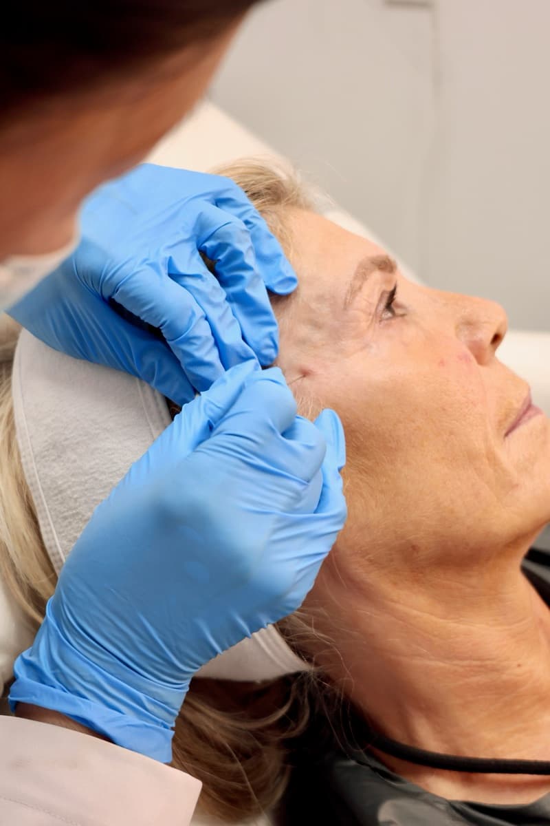 Client receiving a thread lift at FusionMed Toronto